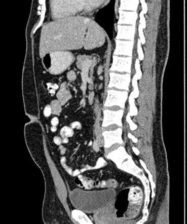 Retropubic Space Radiology Reference Article Radiopaedia Org