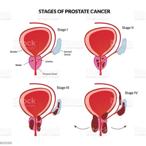 Four Stages Of Prostate Cancer Stock Illustration Download Image Now