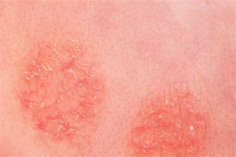 Types And Treatments Nummular Eczema Eczema Awareness Monthly An