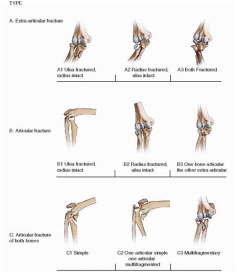 Olecranon Fractures Core Em