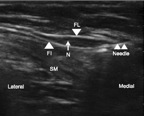 Figure From Ultrasound Guided Lateral Femoral Cutaneous Nerve Block