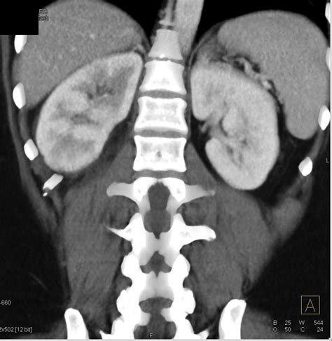 Acute Pyelonephritis Right Kidney Kidney Case Studies Ctisus Ct