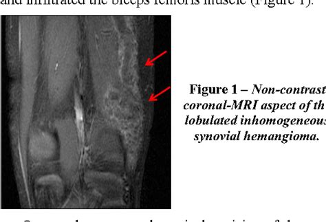 Figure 1 From Arteriovenous Synovial Hemangioma Of The Popliteal Fossa