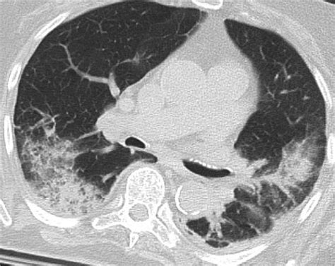 Preoperative Ct Scan Showing Bilateral Patchy Consolidation And