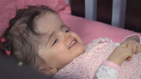 Girl 2 Survives Drastic Surgery To Reconstruct Her Skull Cbc News