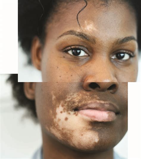 The Skin Disorder Vitiligo Is Changing Jasmine Colgan And Those She