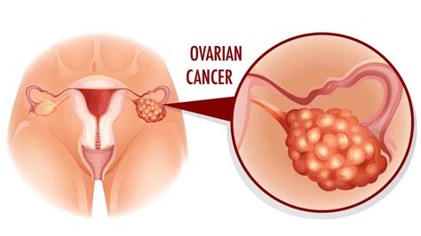 5 Early Warning Signs Of Ovarian Cancer To Never Ignore