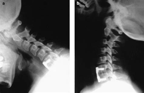 Unilateral Cervical Facet Fracture Presentation Of Two Cases And