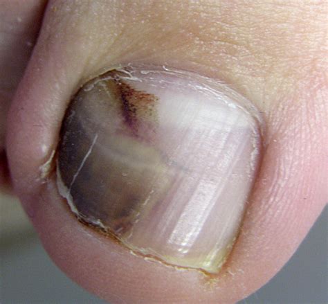 Causes Of Nail Hyperpigmentation Justinboey