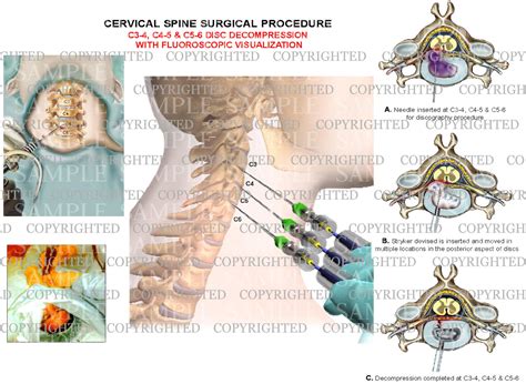 3 Level C3 4 C4 5 And C5 6 Cervical Spien Decompression Surgery Wit