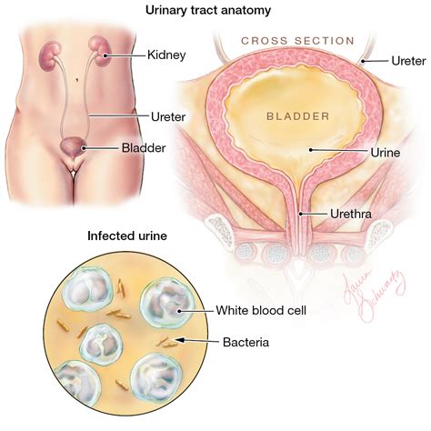 Urinary Tract Infection Infectious Diseases Jama Jama Network
