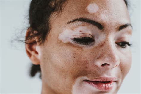 permanent makeup for vitiligo in india saubhaya makeup