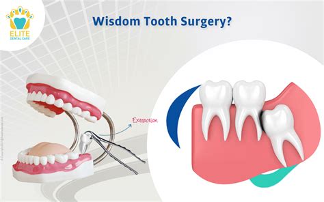 Wisdom Tooth Surgery Everything You Need To Know Elite Dental Care