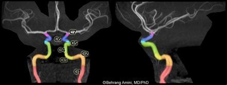 Internal Carotid Artery Radiology Reference Article Radiopaedia Org