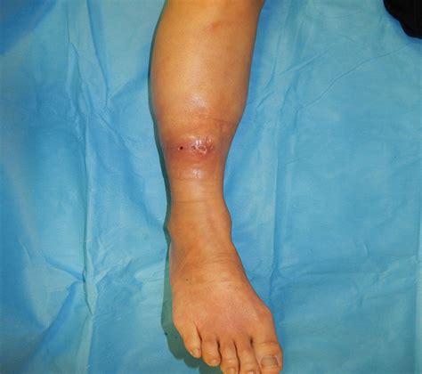 A Case Of Traumatic Intractable Leg Ulcer With Lymphorrhea D