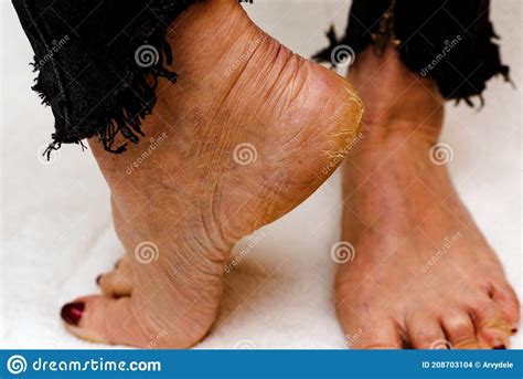 Dry And Cracked Soles Of Feet Womans Feet With Dry Heels Cracked Skin