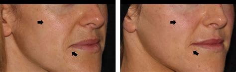 Dermal Fillers For Droopy Corners Of Mouth At Define Medical Clinic