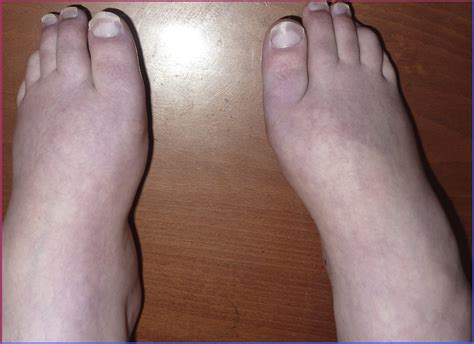 You can fix hammer toes in the following ways: Hammer Toe Repair Pinning - Chantell Leyden