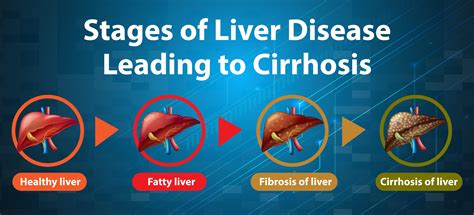 Stages Of Liver Disease Educational Banner 1337819 Vector Art At Vecteezy