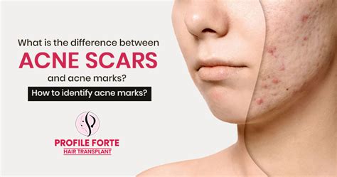 What Is The Difference Between Acne Scars And Acne Marks How To