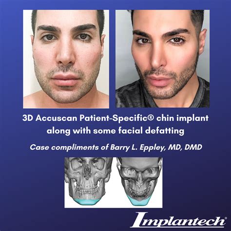Pin By Merc On Plastic Surgery For Men111518 Chin Implant Male