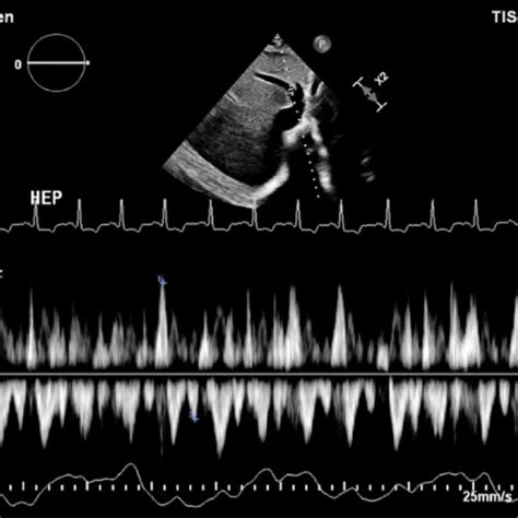 Echocardiogram Showing Diastolic Hepatic Vein Flow Reversal Download