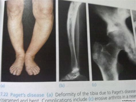Metabolic Bone Disease Pptx د هشام Muhadharaty