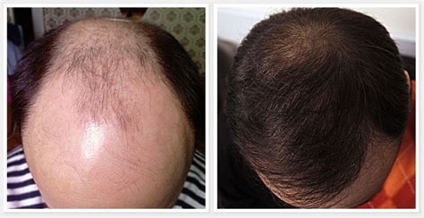 I saw immediate results the first two years and it slowly faded thereafter. 10 Promising Scientific Treatment which could Prevent Hair ...