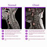 Pictures of Chiari Pain Management