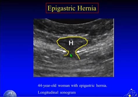Finally We Have An Incisional Hernia