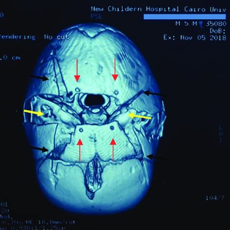 Rt And Lt 2 Nd Day Post Operative 3d Reconstruction Ct Skull Showing