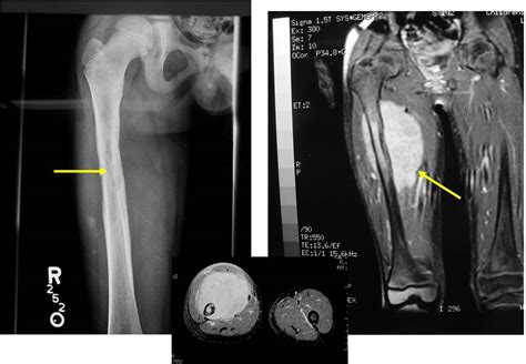 Ewing Sarcoma X Ray