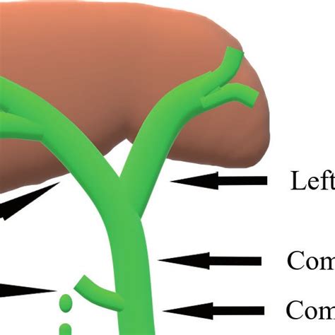 Schematic Image Of Occluded Aberrant Right Hepatic Duct Type B