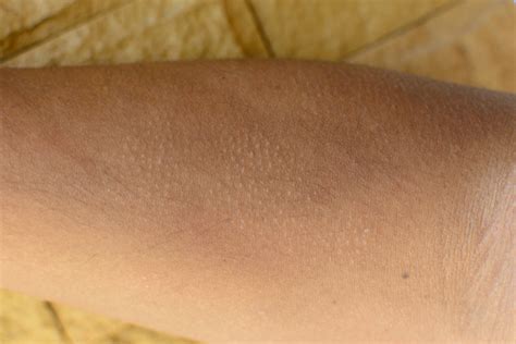 Skin Condition Keratosis Pilaris