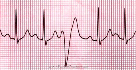 Pvc Ekg Theyre One Of The Most Common Forms Of Heart Arrhythmia And