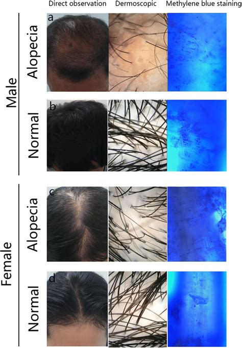 Observation Of Scalp Condition From Healthy Individuals And Alopecia