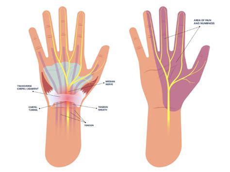 Carpal Tunnel Syndrome Pain Hand Diagram Propel Physiotherapy Propel