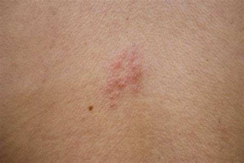 Top 19 Stages Of Shingles Rash Pictures 2022