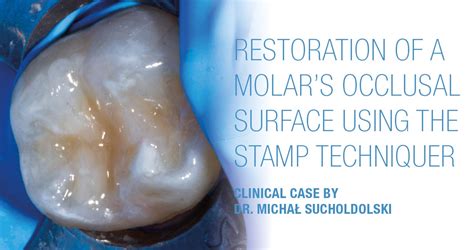 Clinical Case Restoration Of A Molars Occlusal Surface Using The