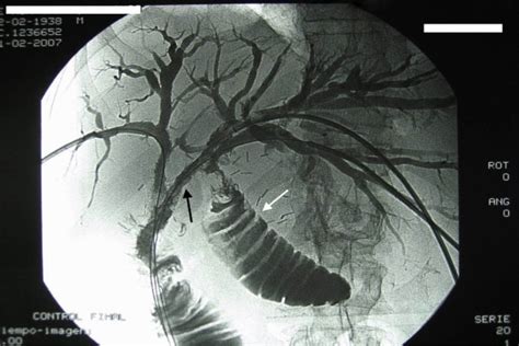En klatskintumör (eller hilärt kolangiocarcinom) är en cancer i gallgångarna som växer från korsningen mellan huvudgångarna i gallvägarna där de möts i levern. Carcinoma de vías biliares. Tumor de klatskin ...