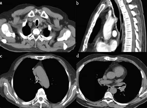 A Axial Ct Slices Showing Tracheal Wall Thickening Contains Calcific