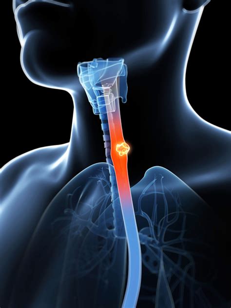 Throat Cancer Warning Signs University Health News