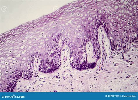 Cancer Of Cervix Light Micrograph Of Cervical Biopsy Photo Under