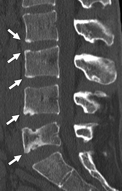 Ct And Mri Of Spine And Sacroiliac Involvement In Spondyloarthropathy Ajr