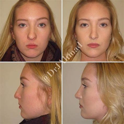 Crooked Nose Before And After 7 Rhinoplasty Cost