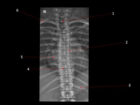 Ap Thoracic Spine Xray Diagram Quizlet