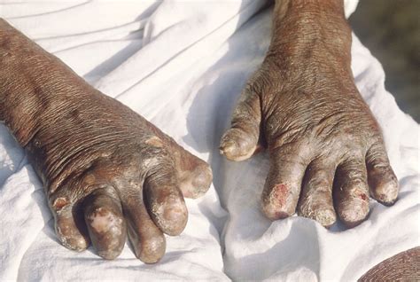 Leprosy or Hansen's Disease: Bacteria and Nerve Damage | YouMeMindBody