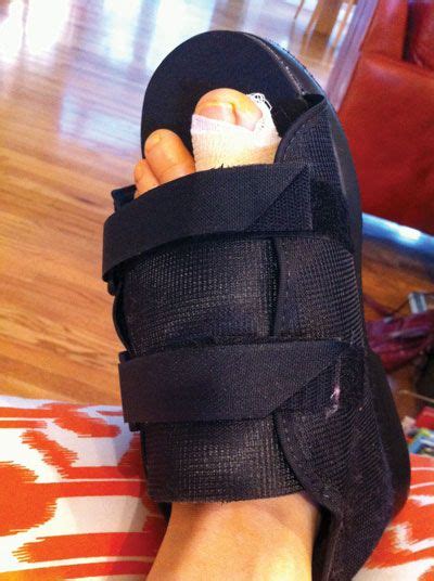 This may cause pain for months or even years after the injury. Figure 1. The soft boot worn immediately after surgery. I ...