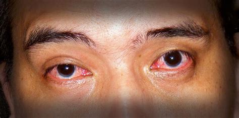 sore eyes, sore eyes question and answers | Firmoo Answers
