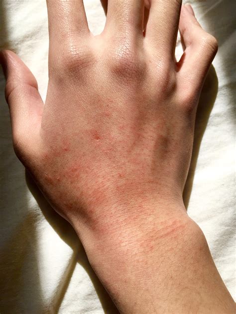 Dry Skin On Hand Became Painful Rash Accutane